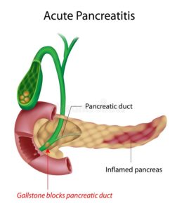 pancreatitis aguda